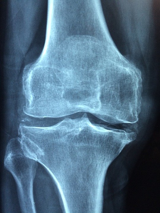 En este momento estás viendo Osteoporosis. Medidas nutricionales para prevenirla